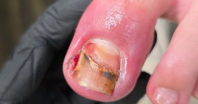 Очень сильно отдавили большие пальцы в обуви. Очень сильно отдавили большие пальцы в обуви.