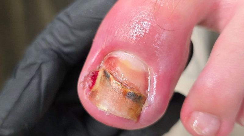 Очень сильно отдавили большие пальцы в обуви. Очень сильно отдавили большие пальцы в обуви.