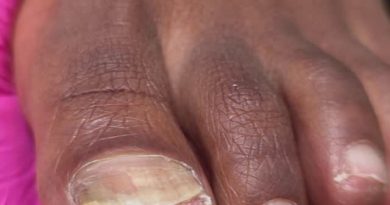 Травматичное подстригание + маленькая обувь + большая нагрузка активного движения весь день и перегрева. Травматичное подстригание + маленькая обувь + большая нагрузка активного движения весь день и перегрева.