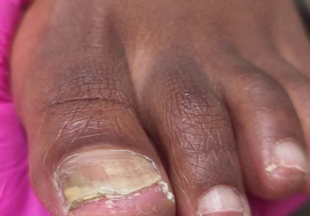 Травматичное подстригание + маленькая обувь + большая нагрузка активного движения весь день и перегрева. Травматичное подстригание + маленькая обувь + большая нагрузка активного движения весь день и перегрева.